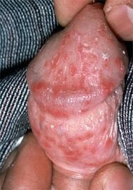 Thrush causes penile discharge