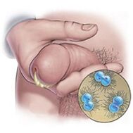 gonorrhea secretion